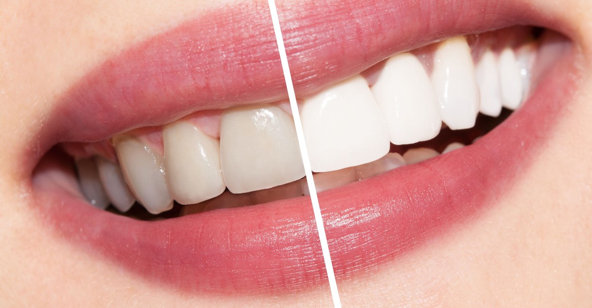 Teeth Whitening Kit Reviews and Summary